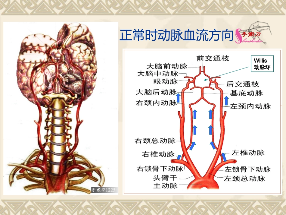 动脉盗血综合征_第2页