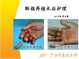 断指再植术后护理