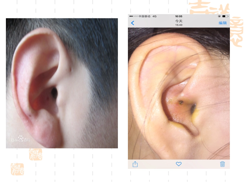 耳前瘘管切开及换药_第3页