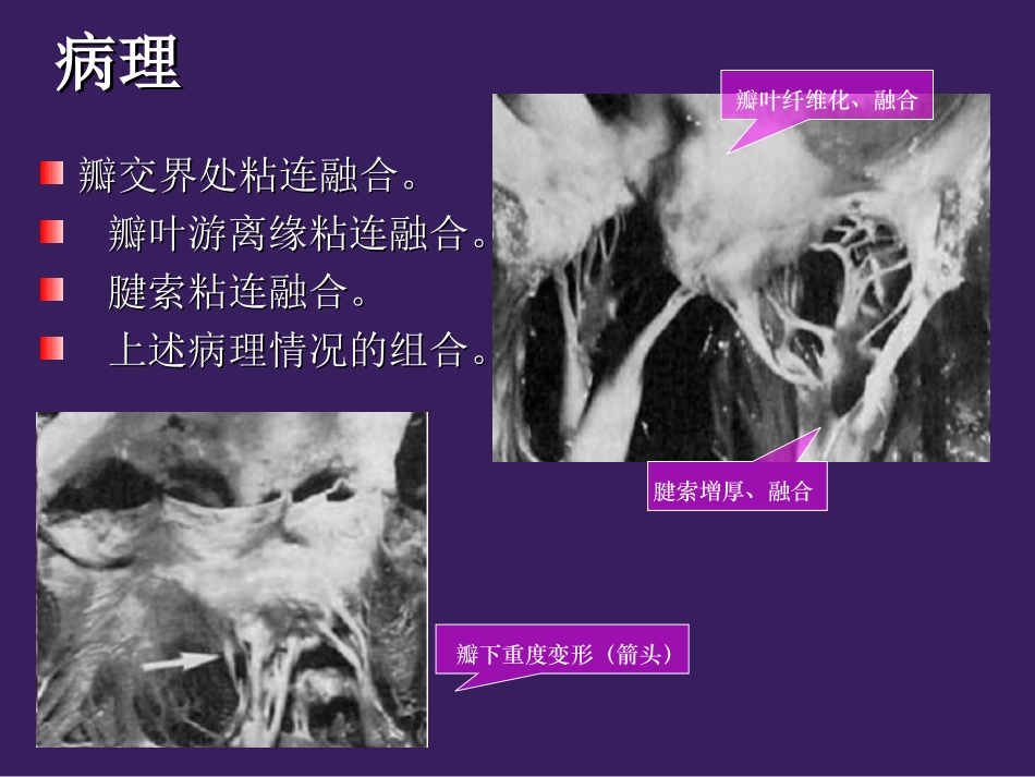 二尖瓣狭窄概述_第2页