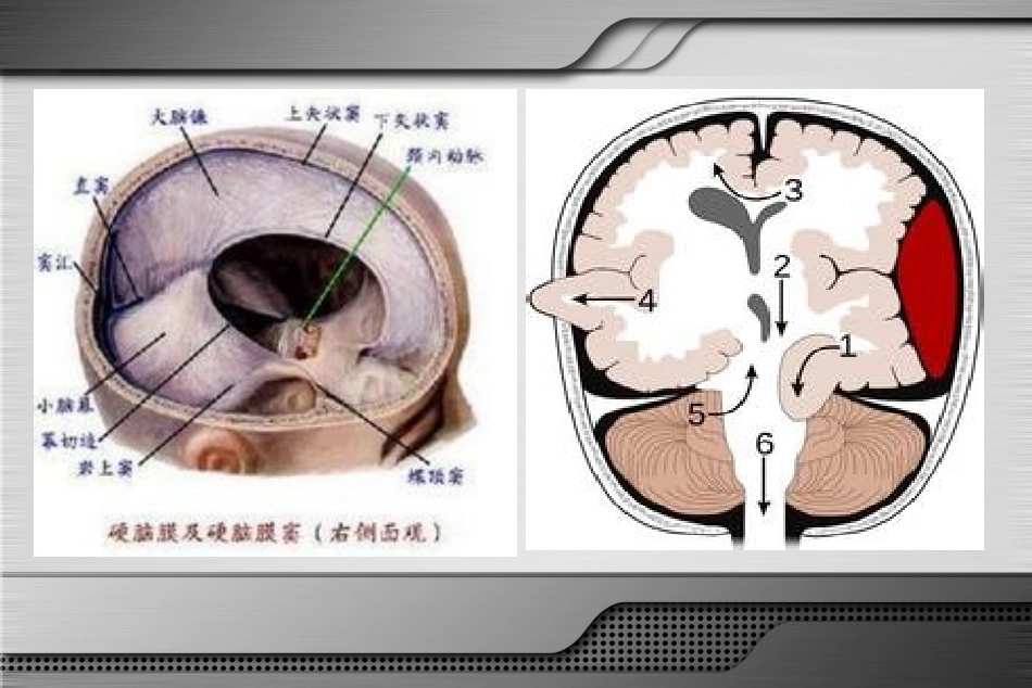 反常性脑疝古磊_第3页