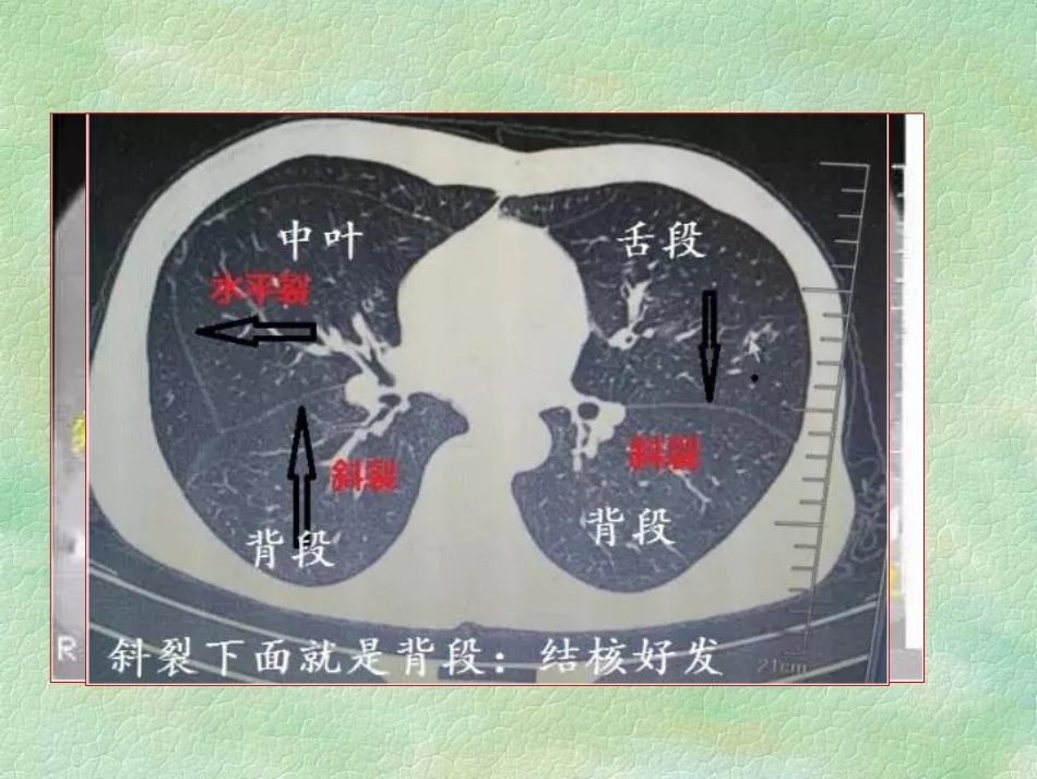 肺结核影像学CT精华版_第3页