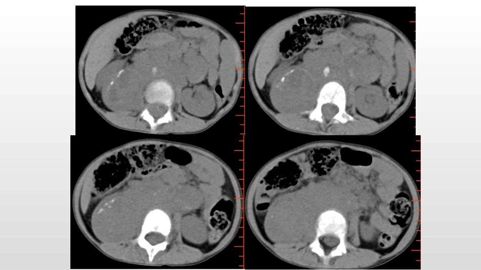 腹膜后神经母细胞瘤_第3页