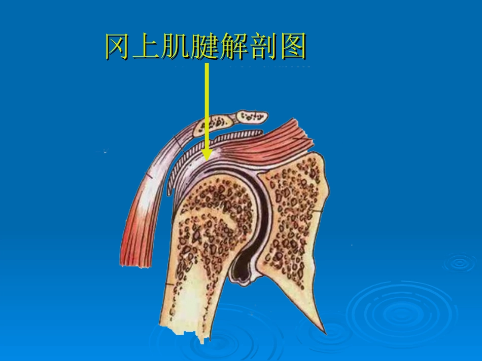 冈上肌肌腱炎讲座_第3页