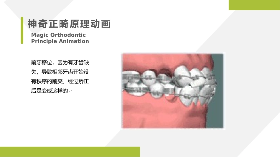 各种畸形牙的矫正过程感受蜕变之美_第3页