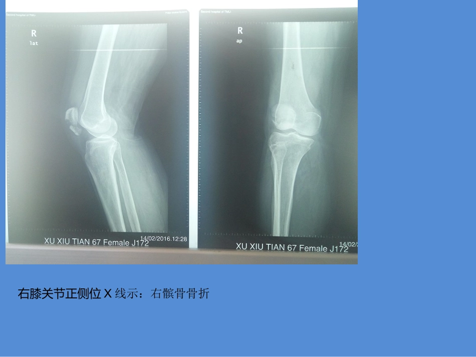 骨科经典病例_第2页