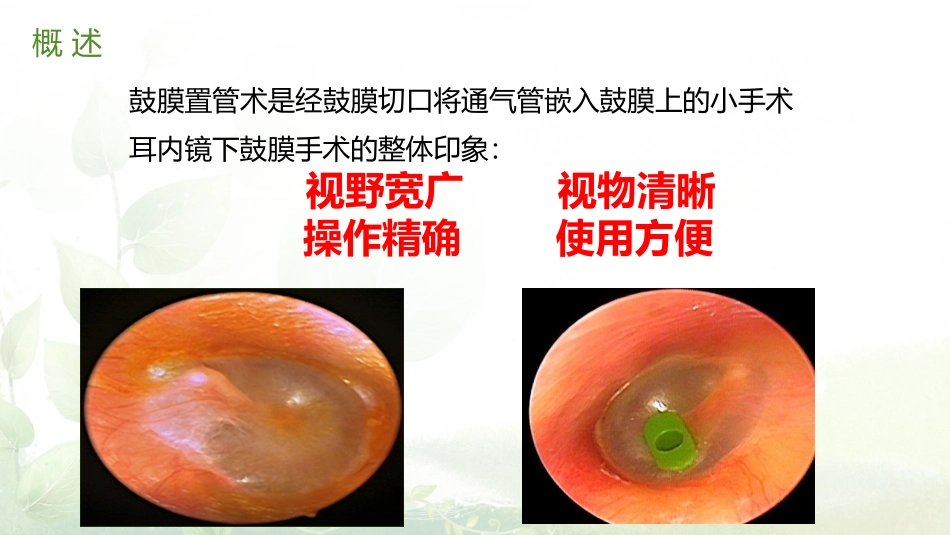 鼓膜置管方法_第2页