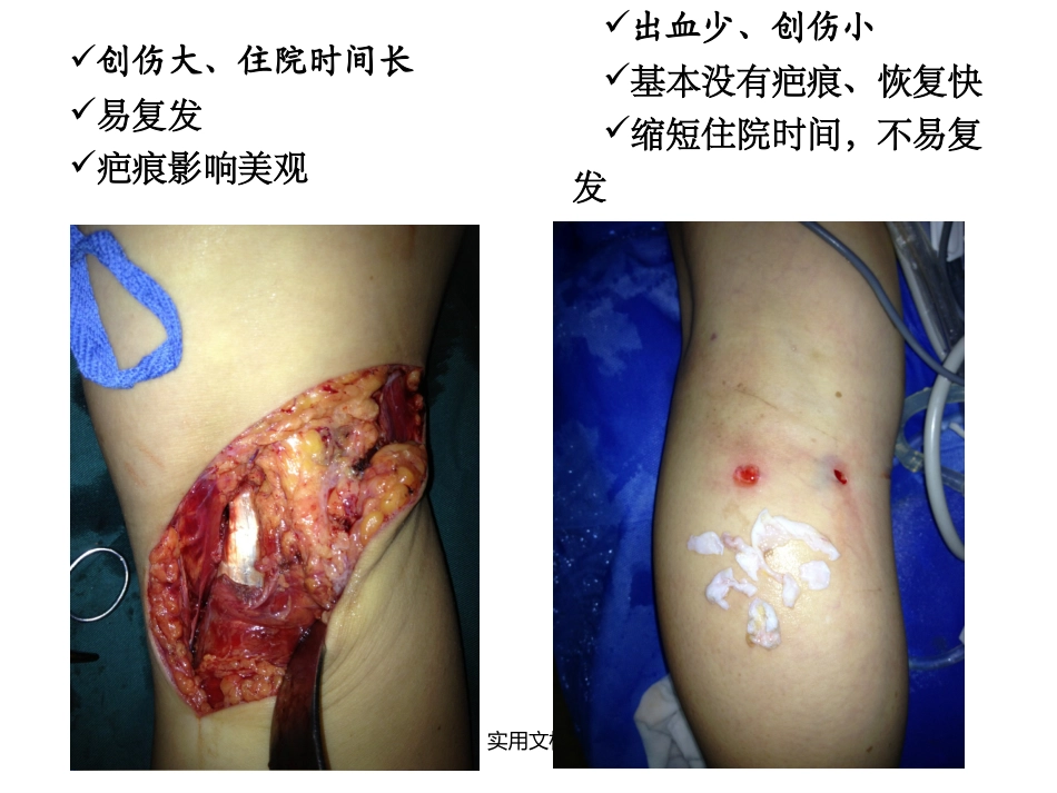 关节镜下腘窝囊肿_第3页