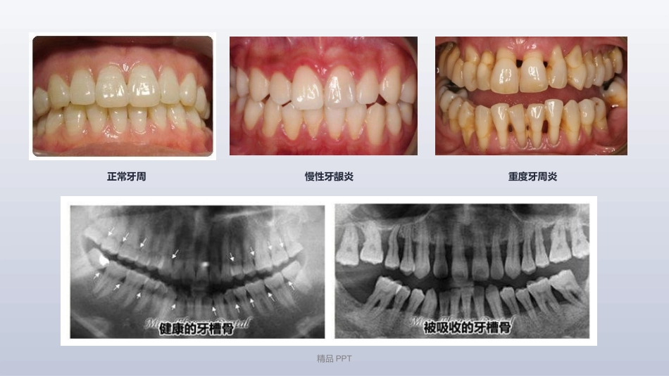 关于重度牙周炎的治疗_第3页