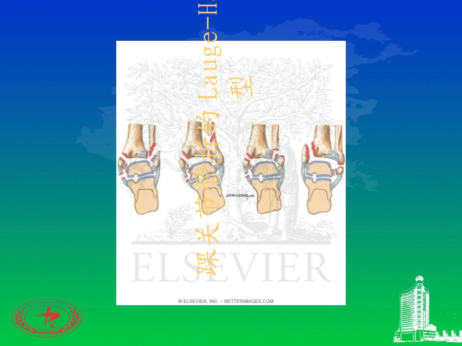 踝关节骨折的LaugeHansen分型_第1页