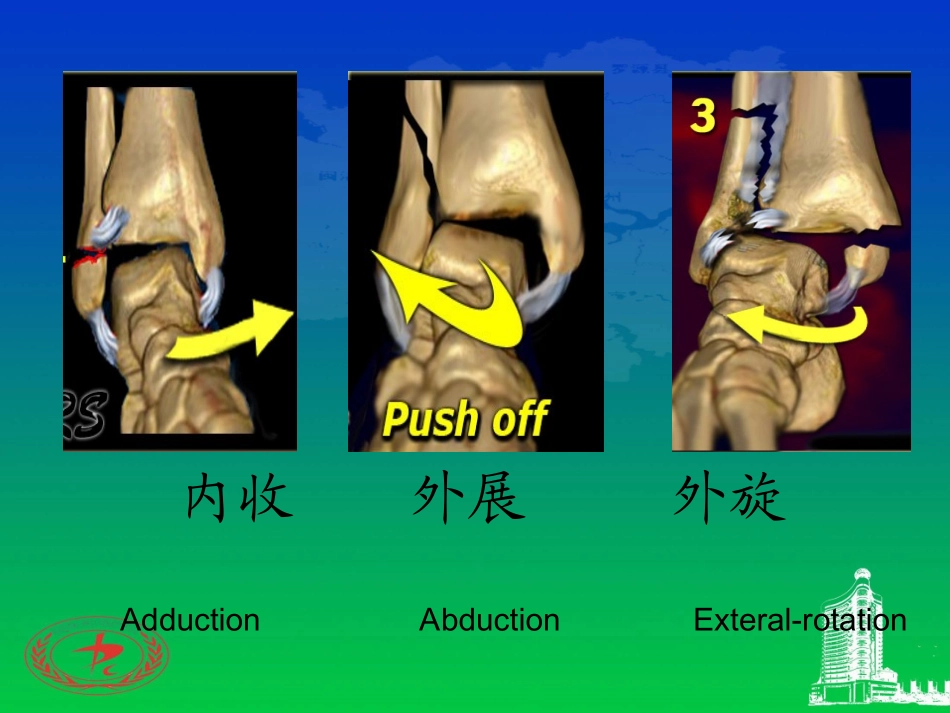 踝关节骨折的LaugeHansen分型_第3页
