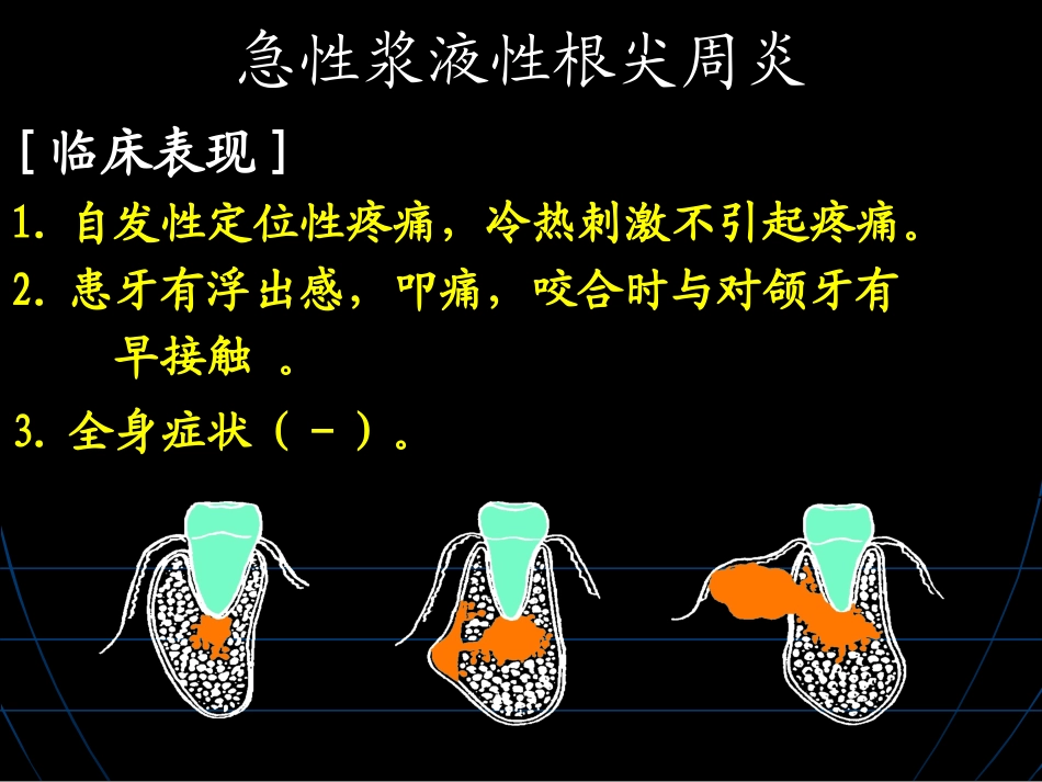 急性根尖周炎概要_第2页