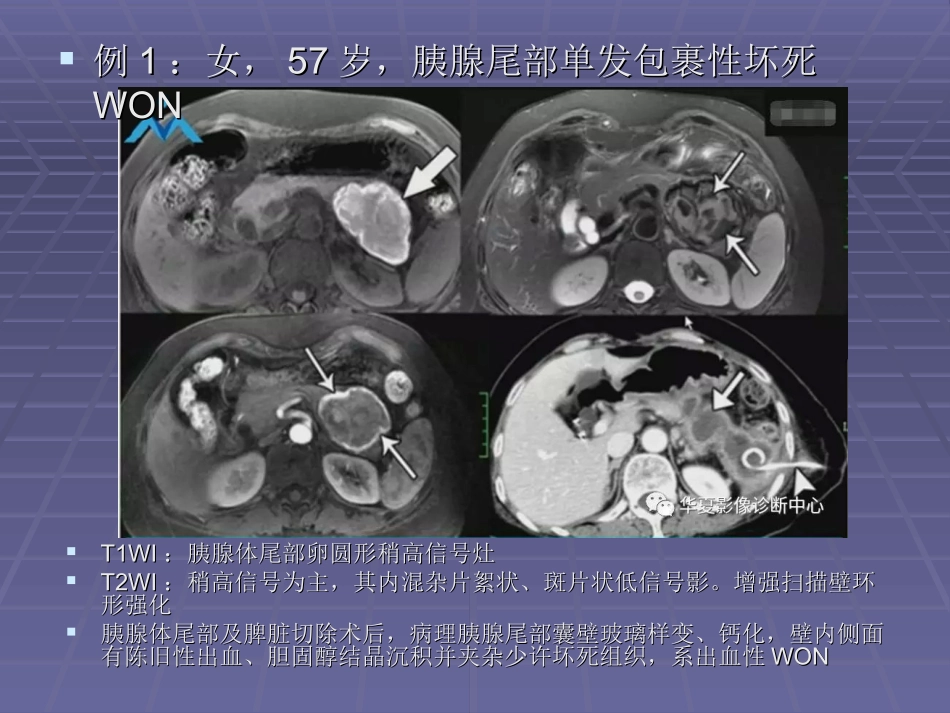 急性坏死性胰腺炎的局部并发症胰腺包裹性坏死WON_第3页