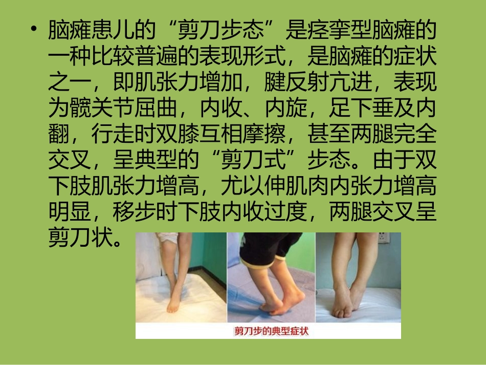 剪刀步态下肢屈膝的家庭康复及训练_第2页