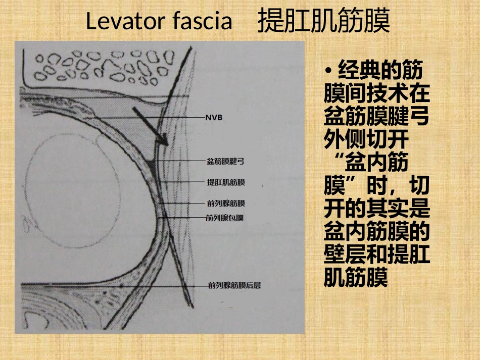 筋膜内根治性前列腺切除术_第2页