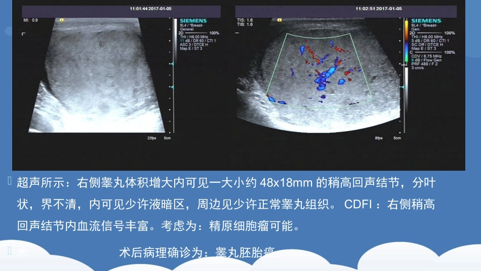 精原细胞瘤及鉴别诊断精品医学_第3页