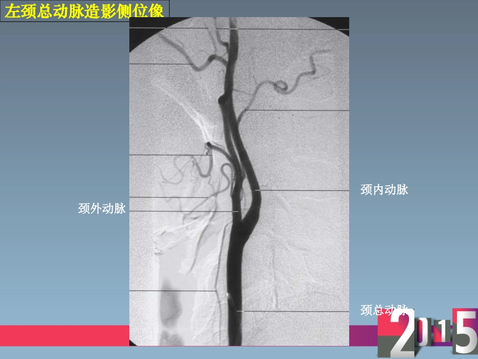 颈内动脉分段和图解讲义_第3页