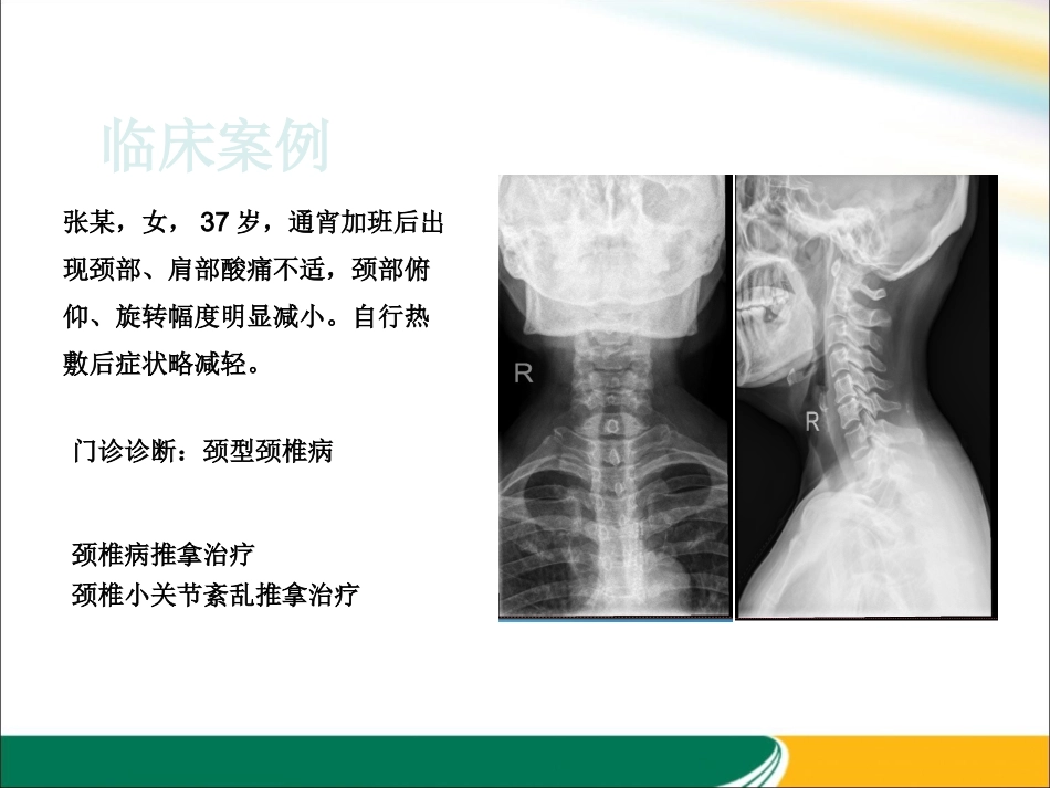 颈型颈椎病课件_第2页