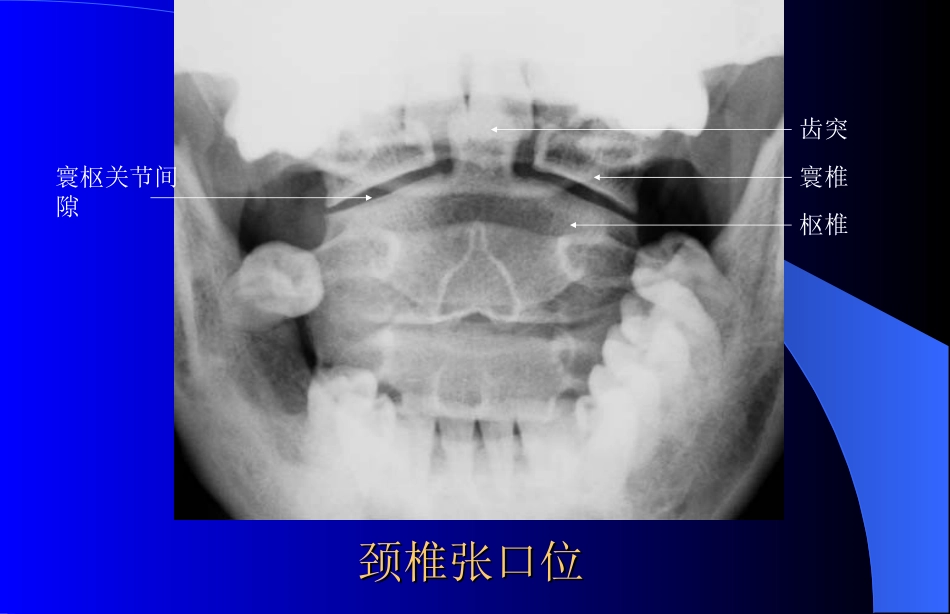 颈椎拍片体位及要点_第3页