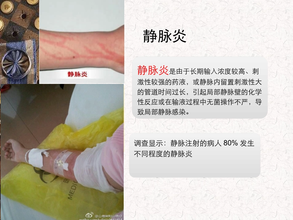 静脉炎的分级和护理_第3页
