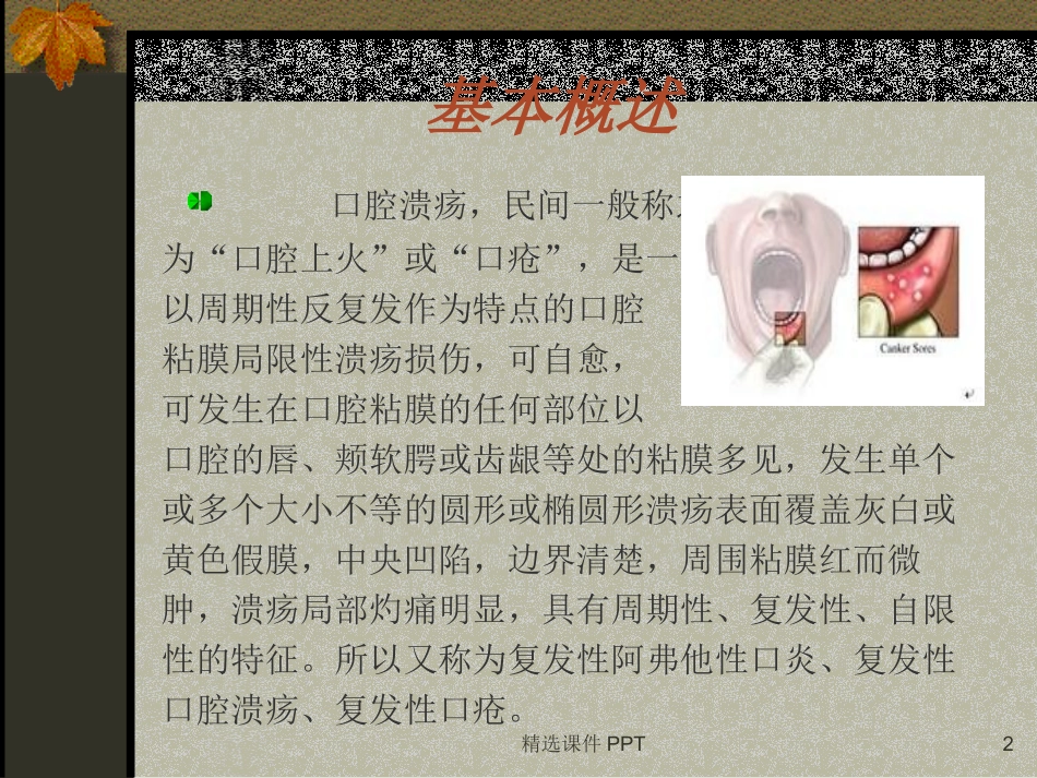 口腔溃疡课件_第2页