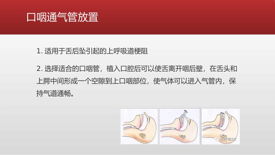 口咽通气道的放置方法和注意事项_第2页