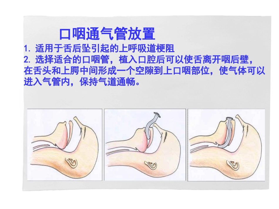 口咽通气管放置_第2页