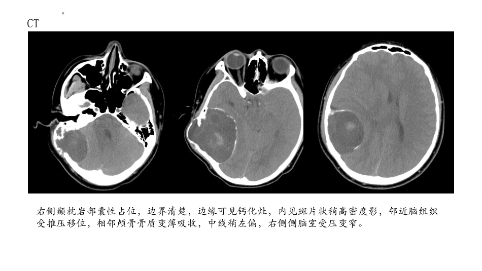 颅内黄色肉芽肿_第2页