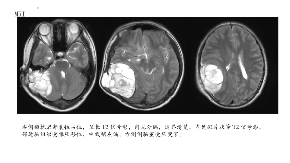 颅内黄色肉芽肿_第3页