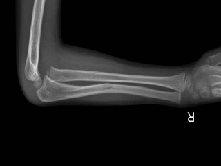 孟氏骨折X线诊疗和分型