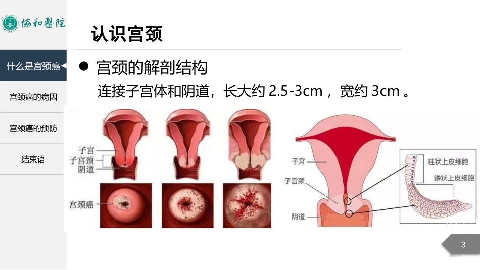 女性宫颈癌小讲课_第3页