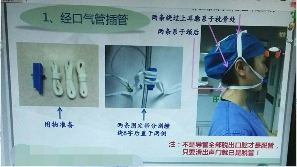 气管插管八字固定法_第3页