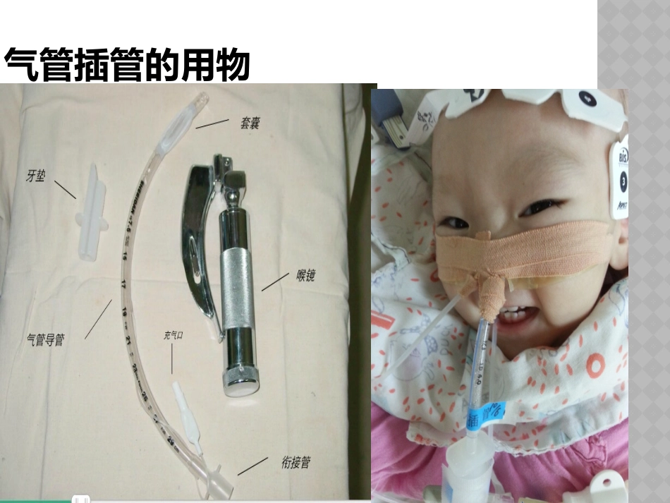 气管插管的拔管流程_第2页
