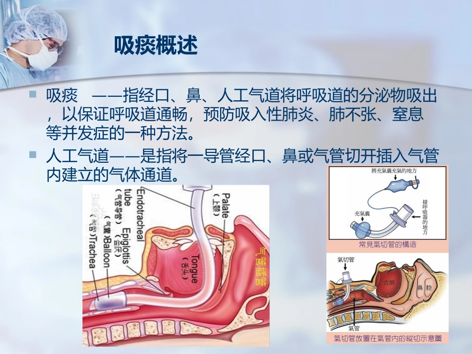 气管插管吸痰术课件_第2页
