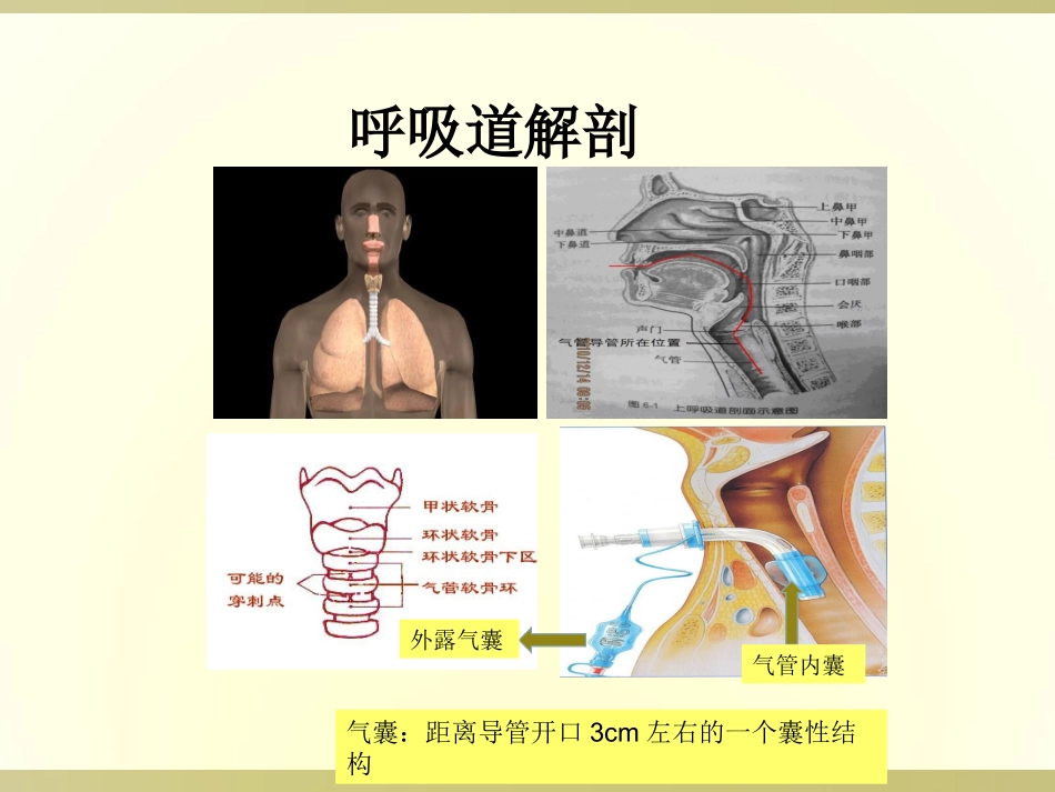 气管套管的气囊管理_第2页