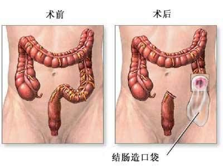 人工肛门的护理讲义_第3页
