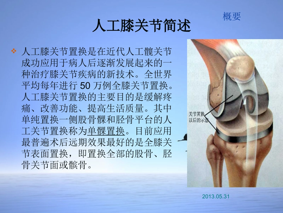 人工膝关节基本知识培训版_第3页