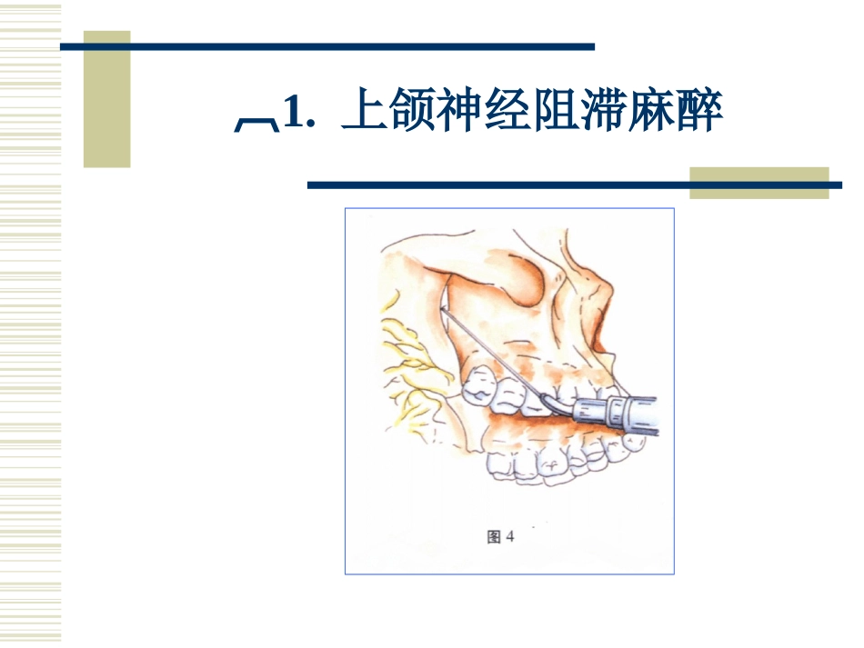 上颌神经阻滞麻醉_第2页