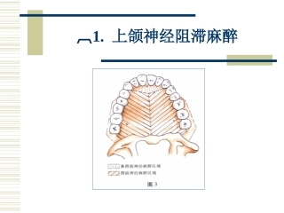 上颌神经阻滞麻醉