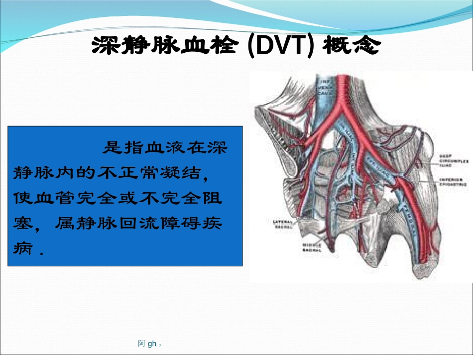 深静脉血栓的评估要点分析_第2页