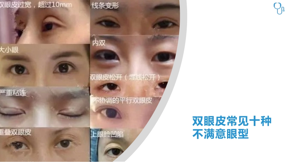 双眼皮失败十大问题剖析与避坑指南_第3页