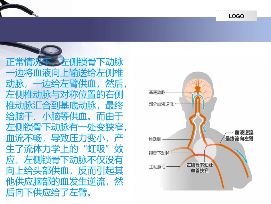 锁骨下动脉支架植入术和术后的护理_第3页