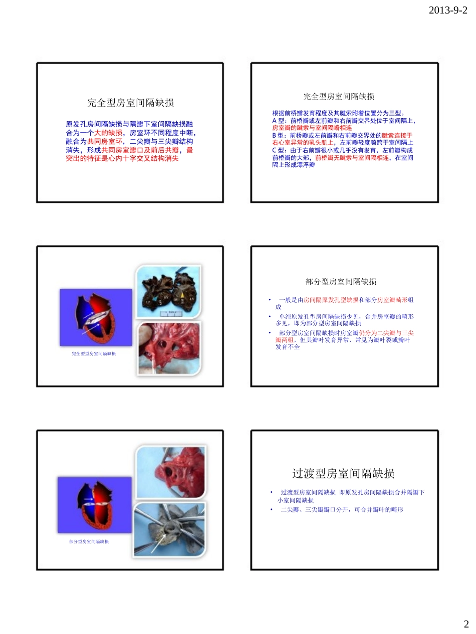 胎儿房室间隔缺损_第2页