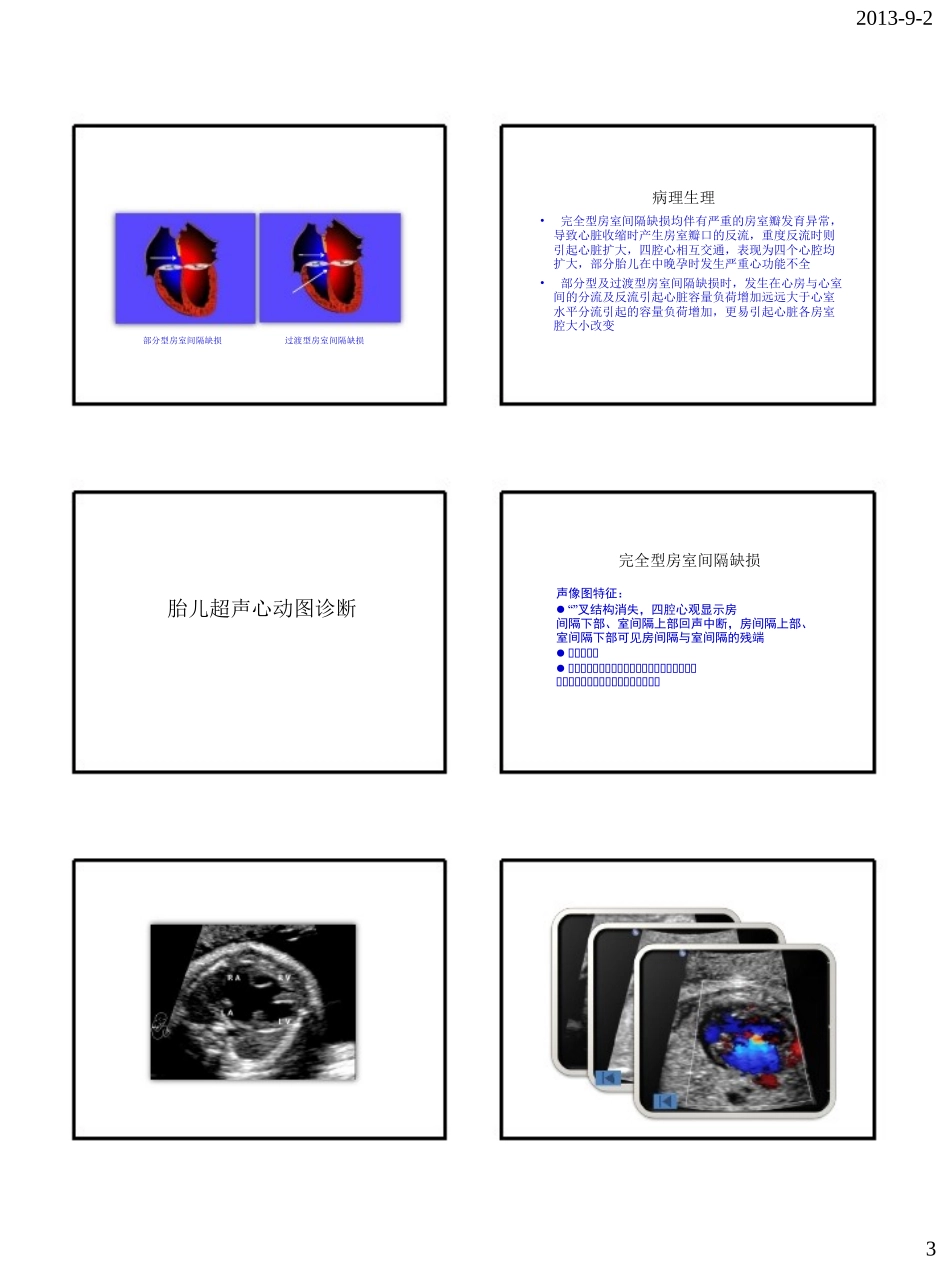胎儿房室间隔缺损_第3页