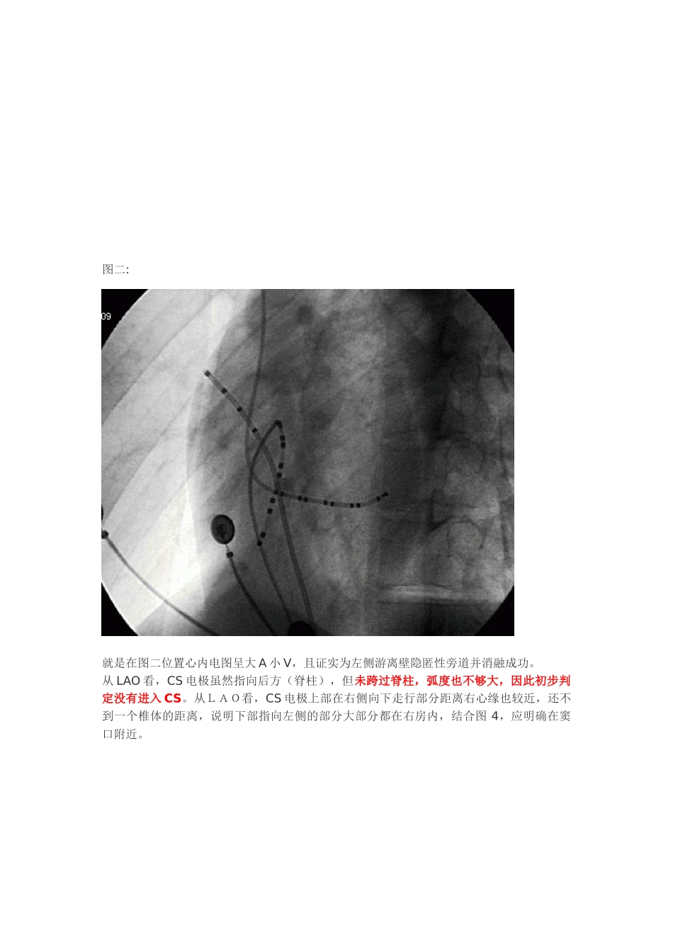 冠状窦电极的放置_第3页