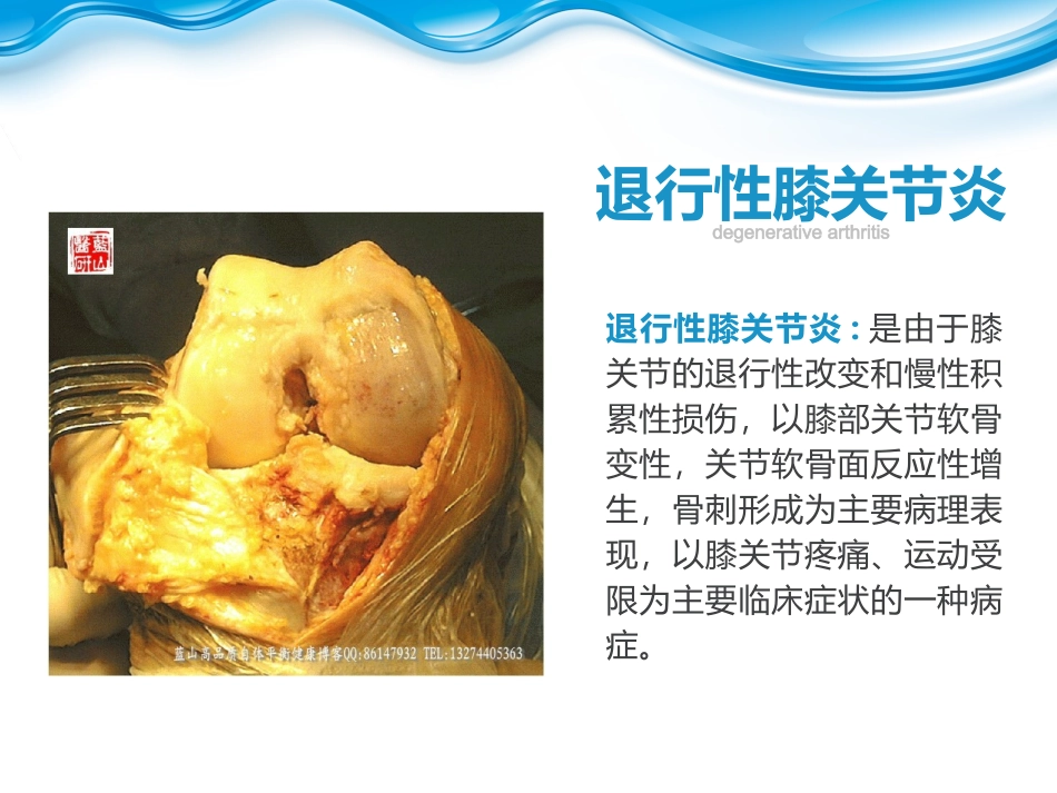 退行性膝关节病变_第2页