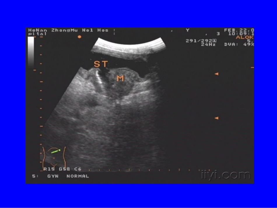 胃癌的超声诊疗_第3页