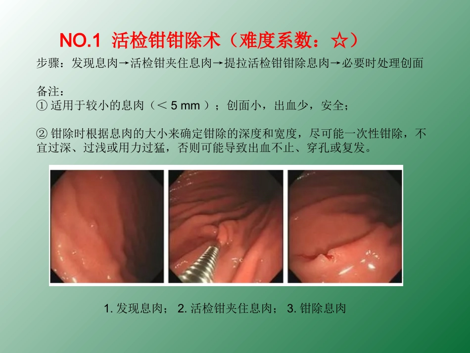 胃肠道息肉的9种切除方法_第3页