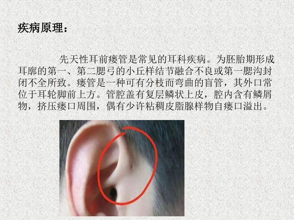 先天性耳前瘘管简介_第2页