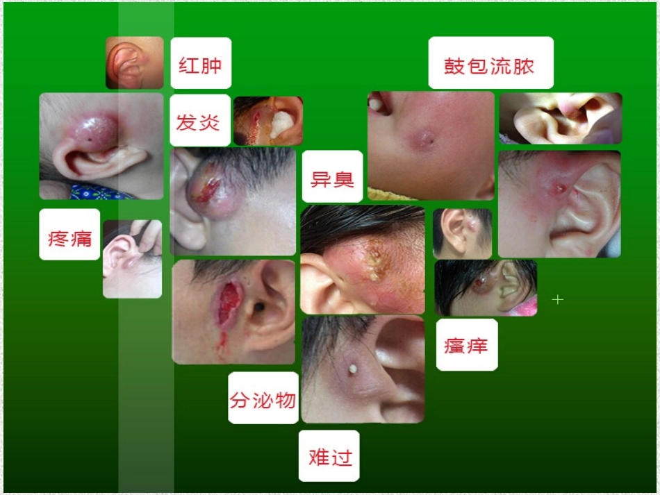 先天性耳前瘘管简介_第3页
